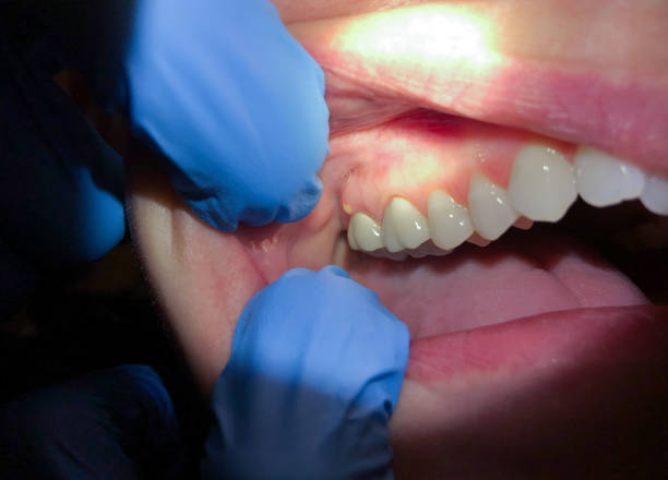 Best Emergency Dentist for Lost Fillings or Crowns in Helena Valley Northwest, MT